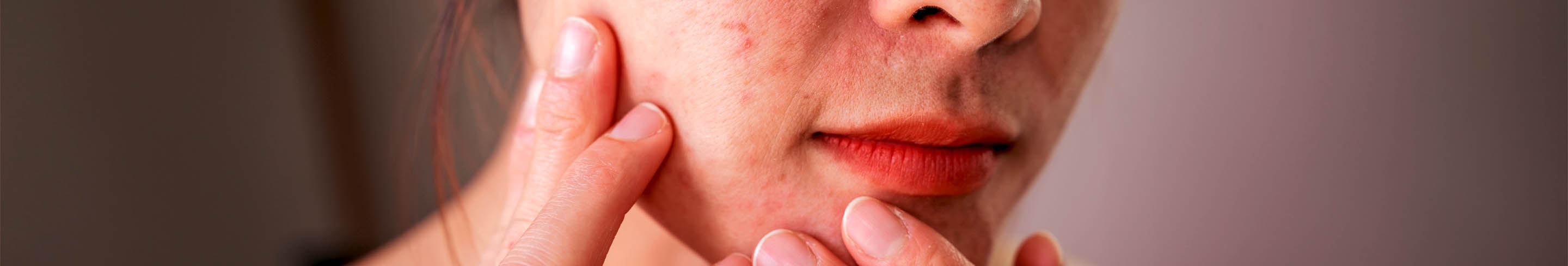 Periorale Dermatitis Banner